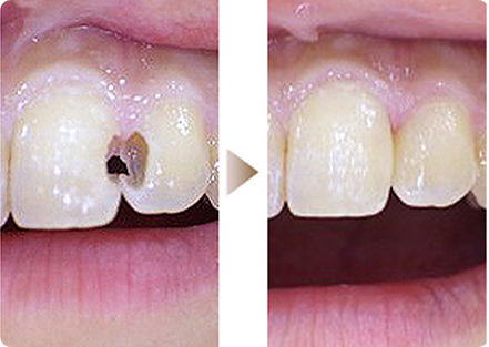 歯の切削量を最小限に抑えるコンポジットレジン治療